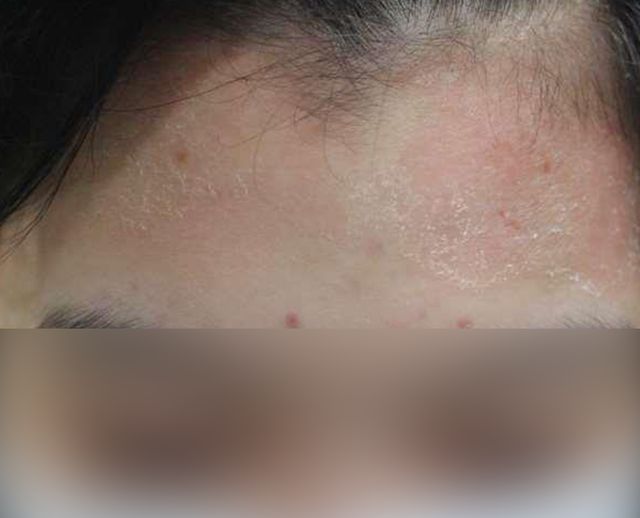 20세 여성 · 3개월 경과 · 치료 전
